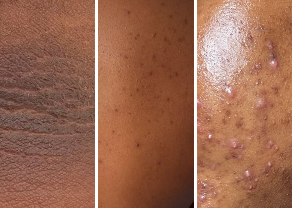Hyperpigmentation, Dark Spots & Body Acne