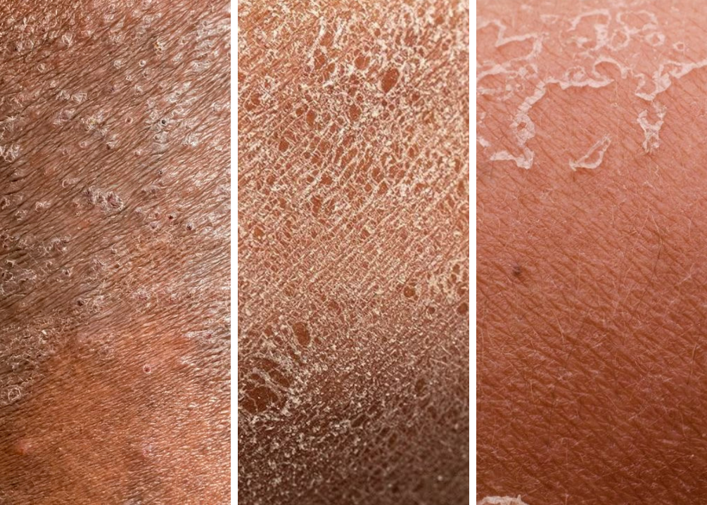 Eczema, Sensitive & Dry skin