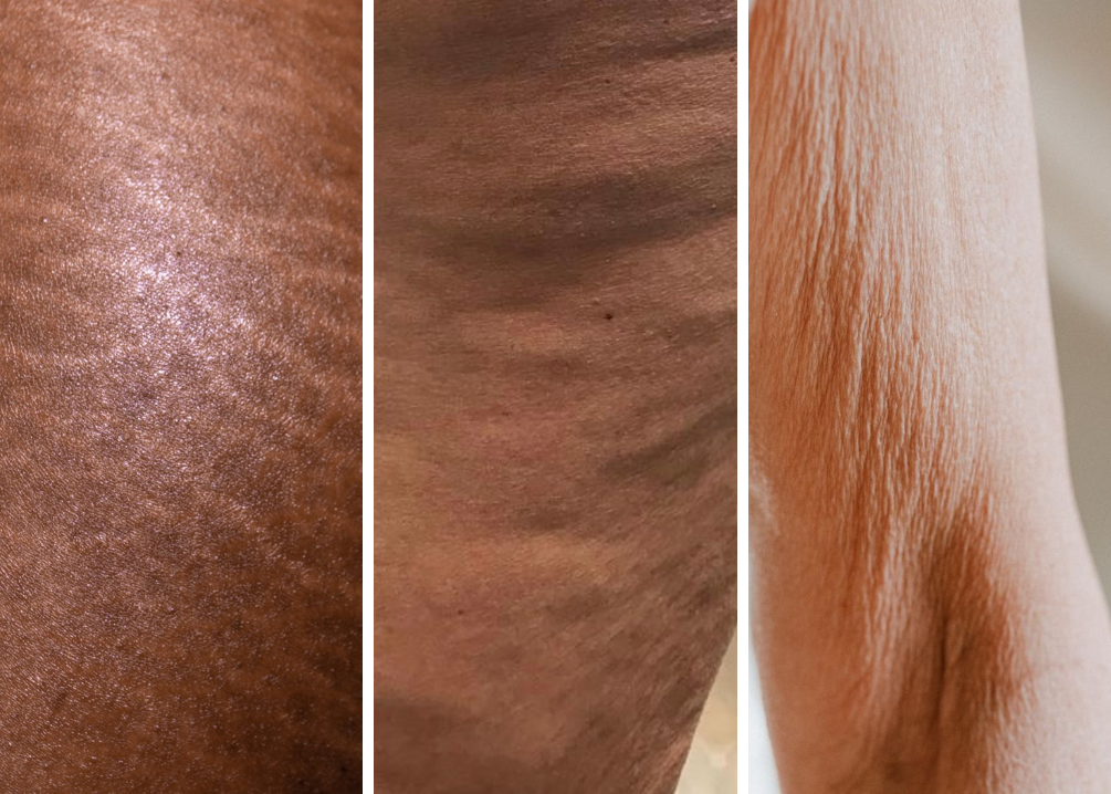 Stretchmarks, Cellulite & Anti-aging